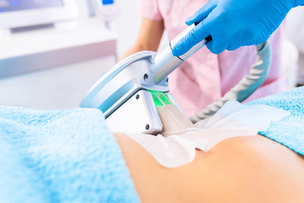 La cryo par Sveltéo Clinic Minceur