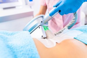 La cryo par Sveltéo Clinic Minceur 